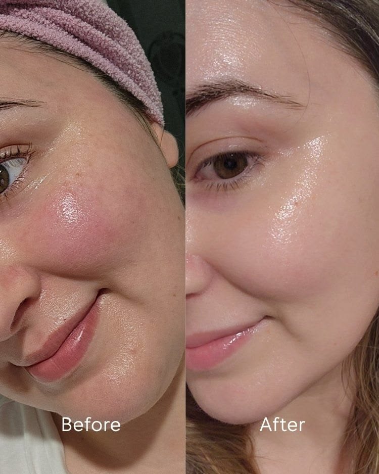 Wiki Special Anti Acne Serum 30ml | Clears Acne & Soothes Skin